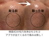 【鼻の黒ずみケア】韓国式３Ｄ毛穴洗浄・鼻のみコース  6800円→5800円