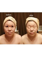 アンジュ/ハイパーナイフ小顔フェイシャル