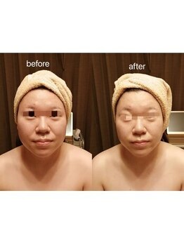 アンジュ/ハイパーナイフ小顔フェイシャル