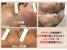 【衝撃の1回体験】シワ・シミ・毛穴まるごと改善！！W幹細胞導入☆9,800円