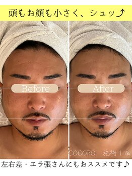 ココロ(COCORO)/劇的変化!骨格から小顔に