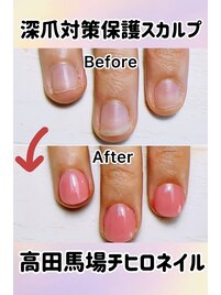 自爪育成・爪噛み保護・深爪対策