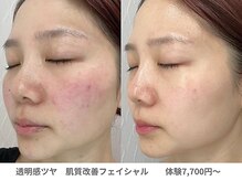 アンシャンテ 芦屋店/開き毛穴　韓国水光肌