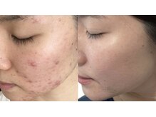 ヨルエステ(yoru aesthe)の雰囲気(繰り返すニキビ、赤みが悩みでしたがホームケア+サロンケア月1)