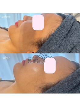 韓国肌管理室pom.haneul【ポムハヌル】LDM/インモード/ララピール/プラピール福岡天神/韓国肌管理室