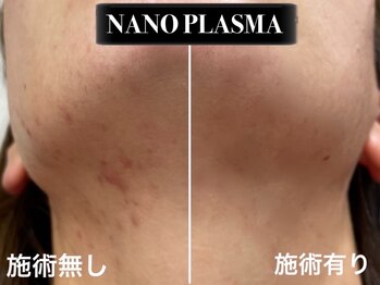 ココリールみき/美容業界注目☆NANO PLASMA導入