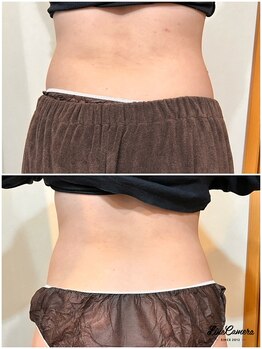 ヒーリングリゾート ナゴミ(Nagomi)/【脂肪冷却】