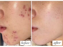 ベルーテ 田町三田(Bellute)/もう肌荒れに悩まされない！