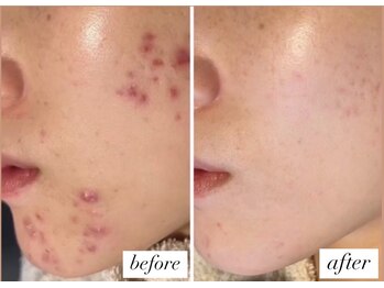 ベルーテ 田町三田(Bellute)/もう肌荒れに悩まされない!