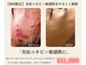 【赤ニキビ×敏感肌に】タラソ導入でやさしく鎮静ケア ¥11,000