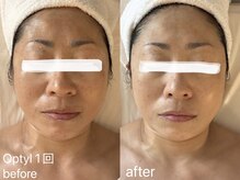 フォー(For...)/高密度超音波Optyl◇たるみケア