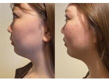 ジーニー(genie)/美容鍼1回Before→After