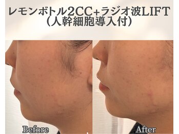 イーラボ 池袋店(e-LABO)/レモンボトル+ラジオ波Lift
