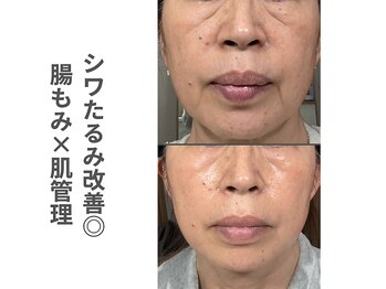 ソルレ 宮崎店(SOLURe)/シワたるみ改善◎腸もみ×肌管理