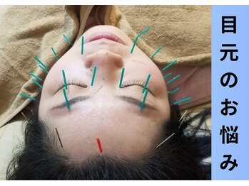 リノ(lino)/美容鍼