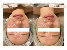 ルプレ(Lupure)/ハーブピーリング１回目