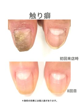 50代/触り癖/3ヶ月後アフター