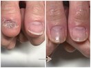 長年悩んでいた爪もこの変化!