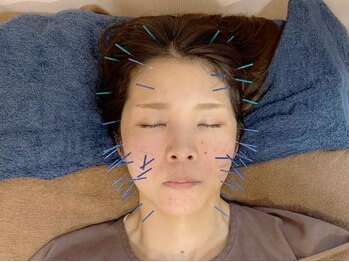 こじま 富雄団地接骨院/ヒト幹細胞美容鍼