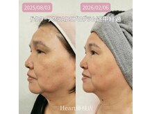 ハート 藤枝店(Heart)の雰囲気(ドクターリセラ導入開始☆シミ改善、リフトアップを短期間で実感)