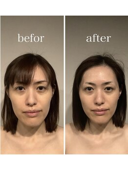 グレースフィオーレ 町田店(gracefiore)/ビフォーアフター/施術1回の効果
