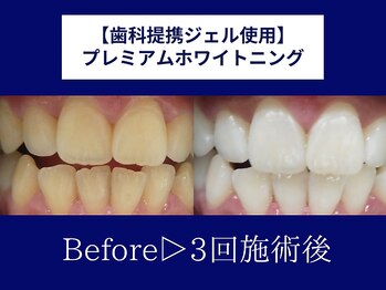ホワイトニングカフェ 岸和田店(WhiteningCafe)/◎歯のホワイトニング施術写真◎