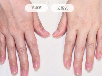 オトナネイル(otona nail)の写真/選べる2種の集中コース＊手にも丁寧なお手入れを。トーン差/痩せ感/ハリ不足などお悩み集中ケアをご用意