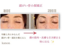 花音/目元も締まります♪小顔矯正