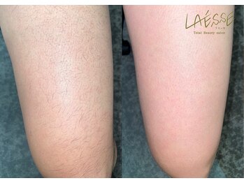 ラエッセ(LAESSE)/<メンズ>膝上脱毛