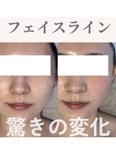 Nビューティー/最新RFサーモシェイプオーパス