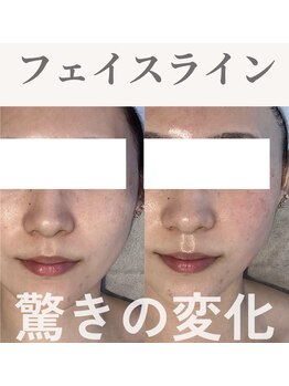 Nビューティー/最新RFサーモシェイプオーパス