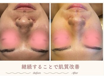 エステティックサロン シーズ/継続はちからなり♪