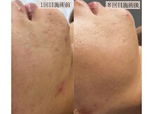 リノン(LINON)/ハーブピーリング 施術回数８回