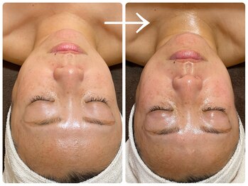 オージャス(OJAS)/40代/ 【小顔フェイシャル】