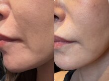 グランディールスイート(GRANDIR suite)/FACE MAKER施術結果
