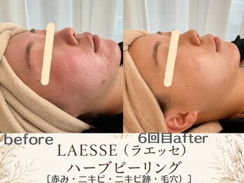 エスポワール(espoir)/赤み・赤ら顔にも効くハーブ!