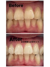 プレジール(PLAISIR)/セルフホワイトニング