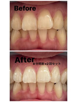 プレジール(PLAISIR)/セルフホワイトニング