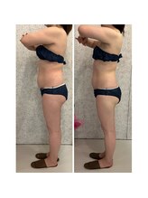 カラーリリー(Calla Lily)/下腹部の厚みのお悩み（初回）