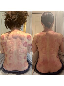 ビレイ(Birei)/カッサ＋カッピング