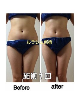 ルラシェ/1回での効果