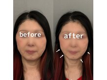 美容鍼１回目。フェイスラインスッキリ◎小顔/たるみ/しわ/毛穴/