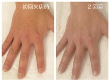 キレイテ 福岡天神店/40代/2回目【博多ハンドケア】