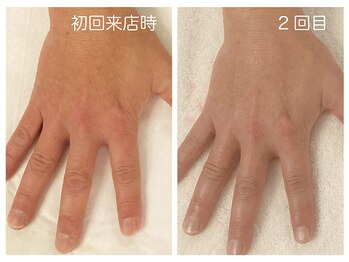 キレイテ 福岡天神店/40代/2回目【博多ハンドケア】