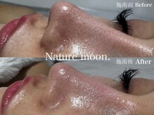 ナチュールムーン(Nature moon.)/毛穴洗浄