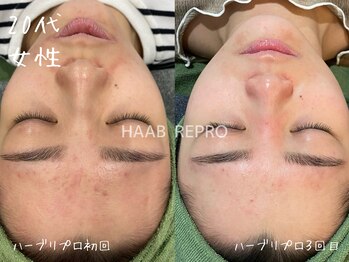 ミコサロン(miko salon)/デトックスハーブピーリング