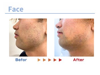 キングスサロン 熊本/メンズ髭脱毛ビフォーアフター