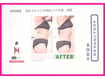 フレクシー/４D　beforeafter