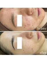 ユニクリア(Uni clear)/ハーブピーリング　ニキビケア