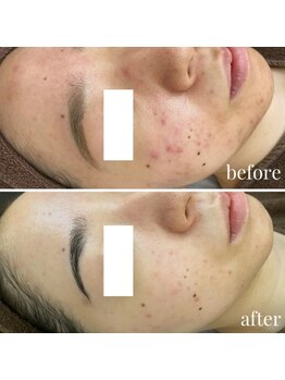 ユニクリア(Uni clear)/ハーブピーリング ニキビケア